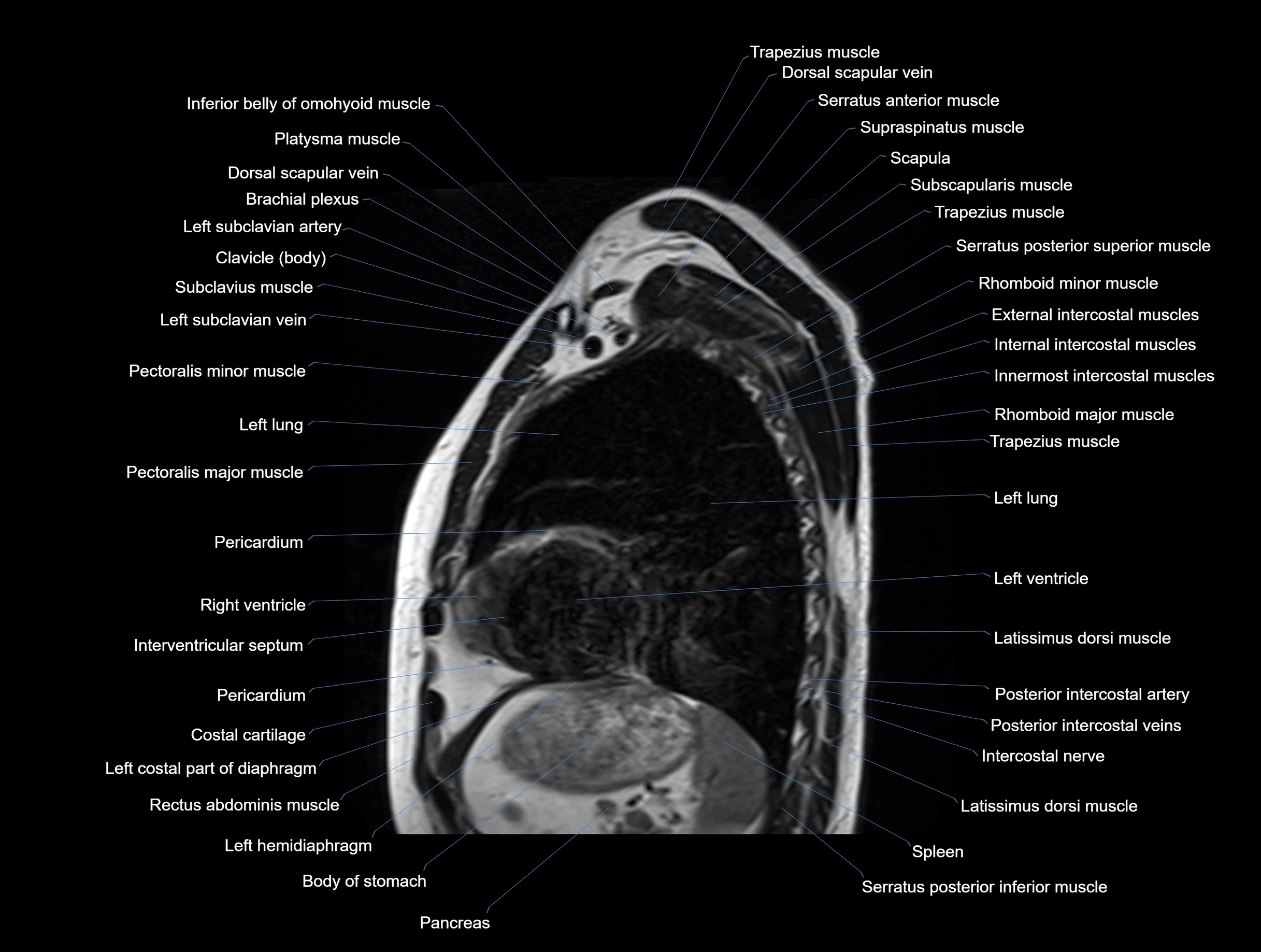 MRI chest (thorax) coronal  cross sectional anatomy 3T radiology  image-img-00001-00028.webp